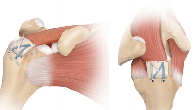 Patch Augmentation Surgery