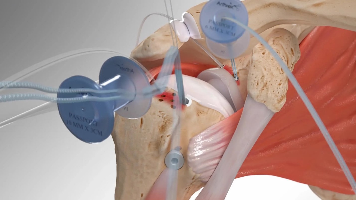 Superior Capsular Reconstruction